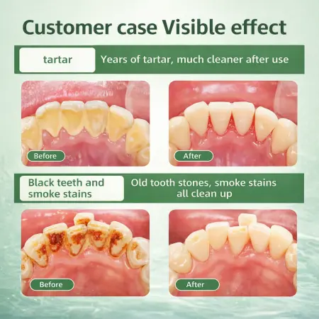 Tartar Remover for Teeth