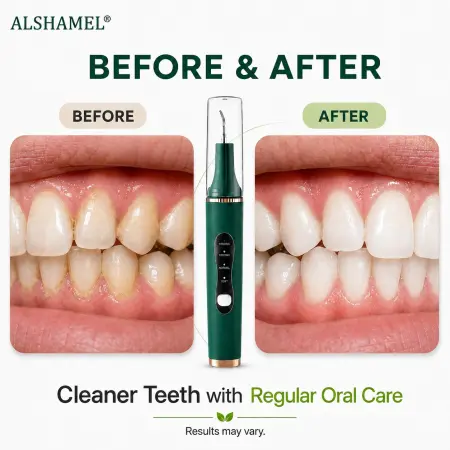 Tartar Remover for Teeth