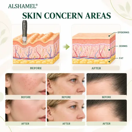 Ultima A6 Microneedling Pen